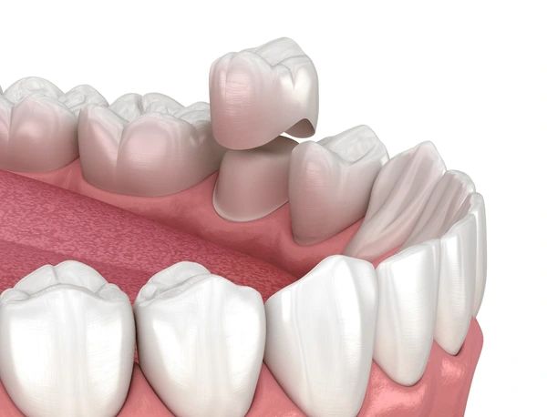 cerec same-day crowns in marion, ma
