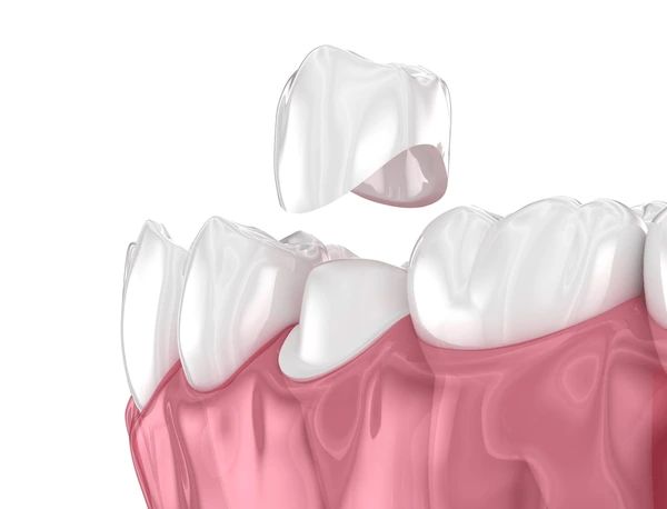 cerec same-day crowns near you