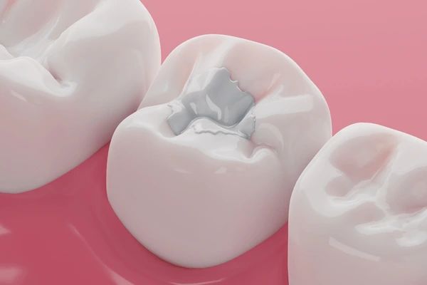 composite fillings in marion, ma