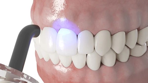 dental bonding in marion, ma