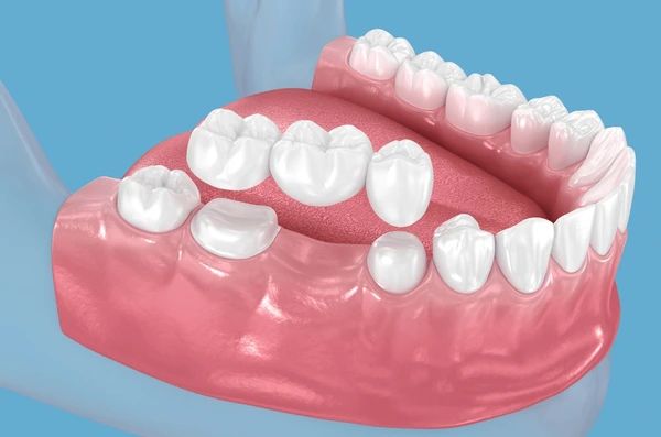 dental bridges in marion, ma