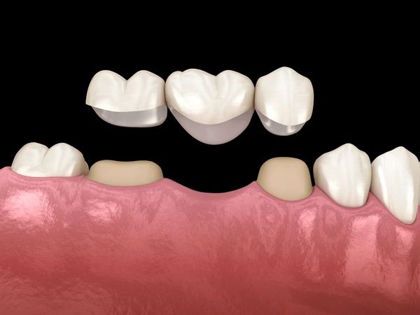 dental bridges near you