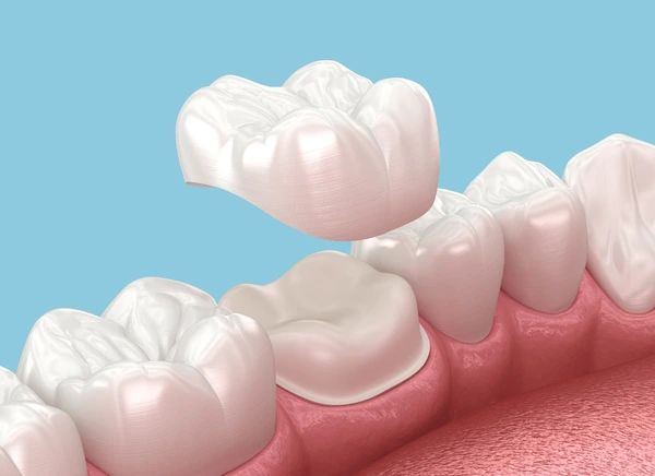 dental crowns near you