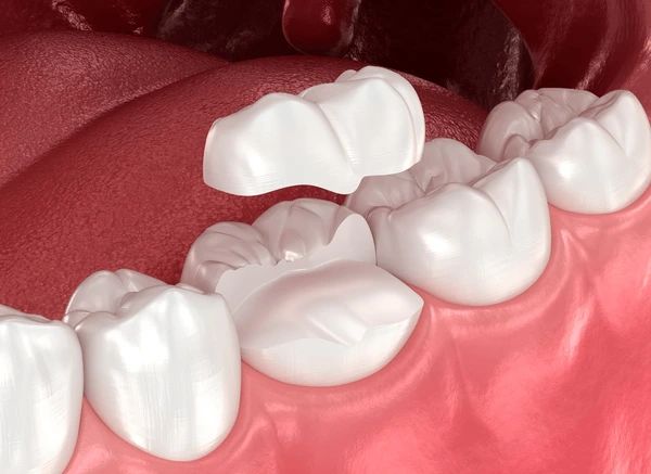 dental inlays and onlays in marion, ma