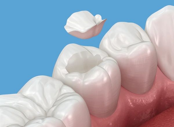 dental inlays and onlays near you