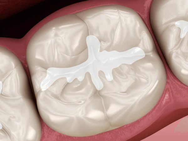 dental sealants near you