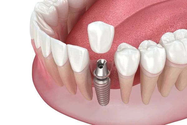 implant crowns in marion, ma