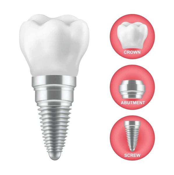 implant crowns near you