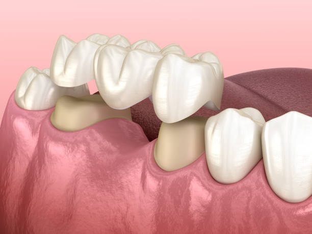 what happens if a dental bridge feels loose