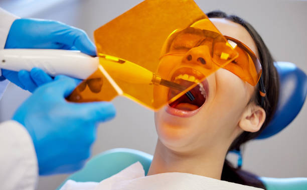 how composite fillings restore cavities naturally